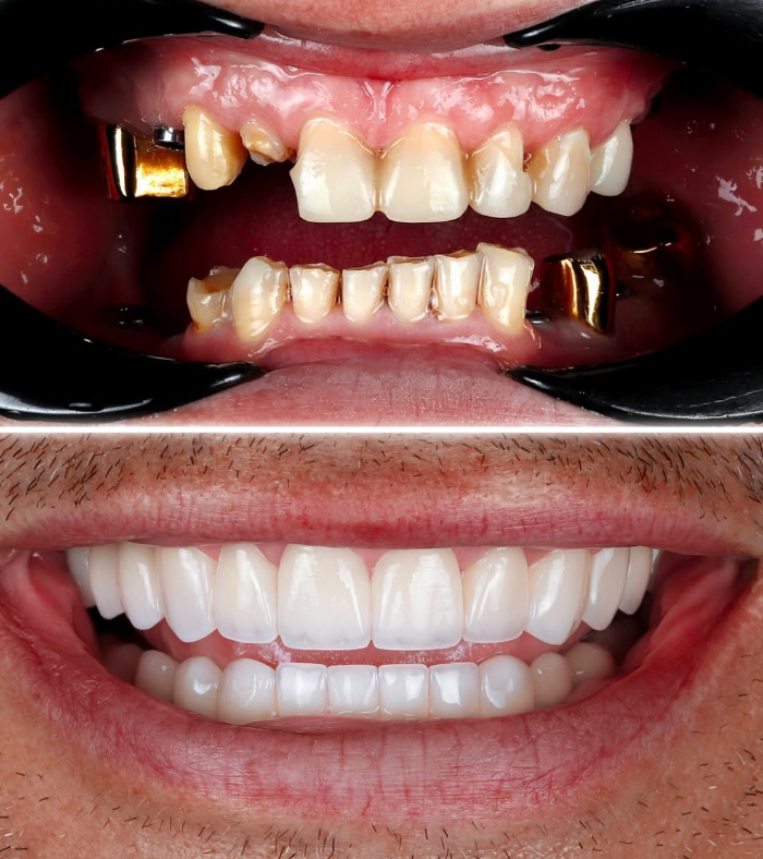 Dental Implants