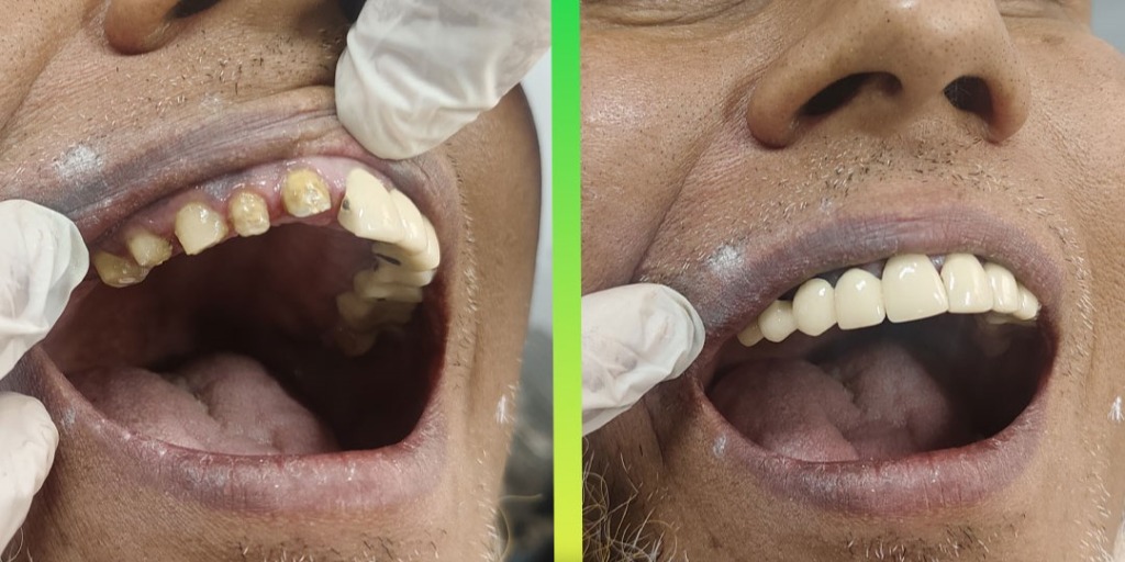Root Canal Treatment